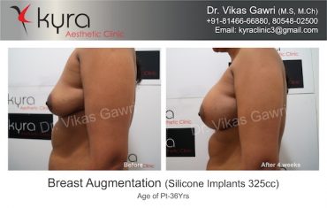 breast-implants-Amandeep kaur 5