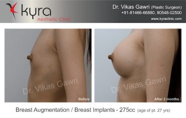 breast-implants-Case 1.3