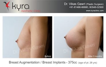breast-implants-Case 2.3