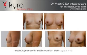 breast implants punjab