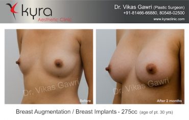 breast-implants-Case 3.3