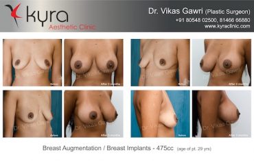 breast implants in ludhiana