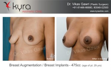 breast-implants-Case 4.2