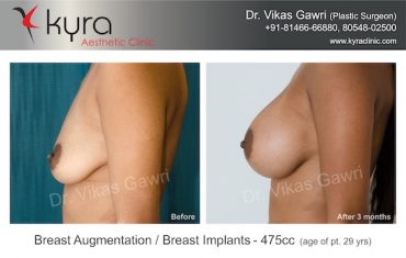 breast-implants-Case 4.3