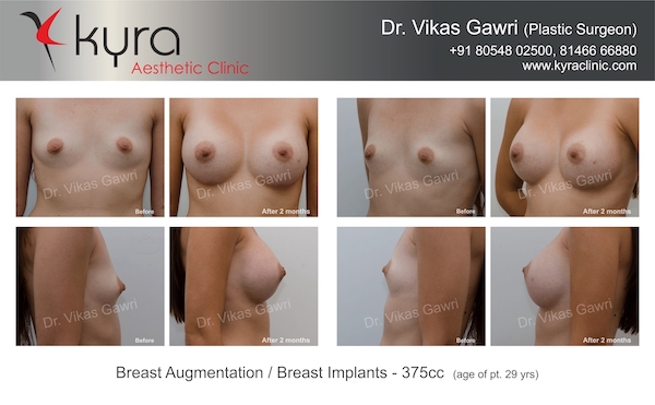 breast implants in chandigarh