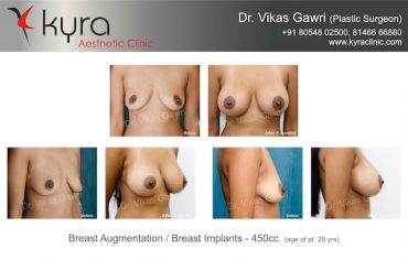 best breast implants ludhiana