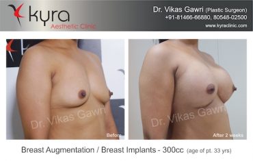 breast-implants-Case 7.2
