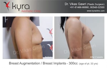 breast-implants-Case 7.4