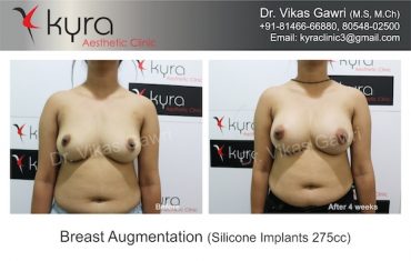 breast-implants-Jyoti 3