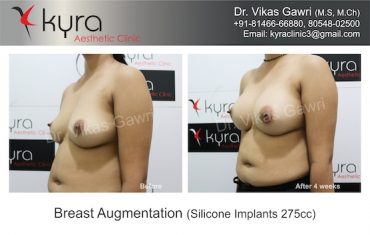 breast-implants-Jyoti 5