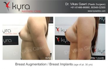 breast-implants-Maanvi Implants 2
