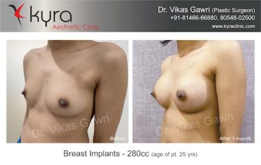 breast-implants-Salma Implants 5