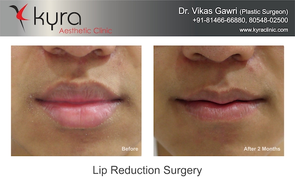 lip reduction surgery female