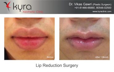 Lip Reduction Surgery 5