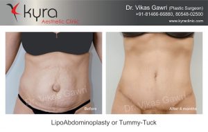 Tummy tuck patient 2