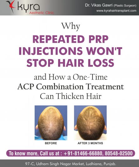 Hair Transplant Growth Timeline | Day By Day Recovery Photos