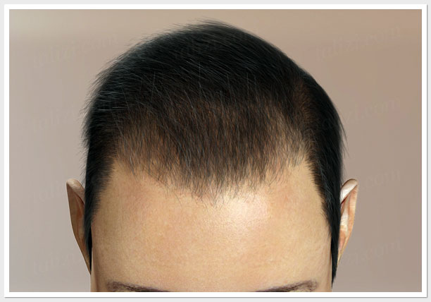 Best FUE Hair Transplant in Los Angeles  Newport Beach 10004000 Grafts