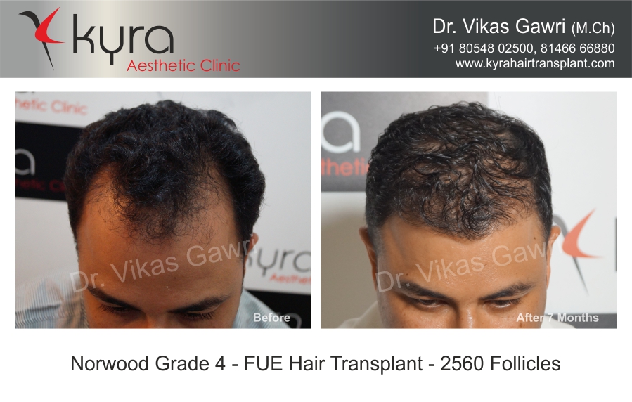 Hair Transplant Procedure - Cosmetic Surgery in Ludhiana, Plastic Surgery  in Punjab, Laser and Cosmetic Surgeon in Ludhiana, Punjab, India