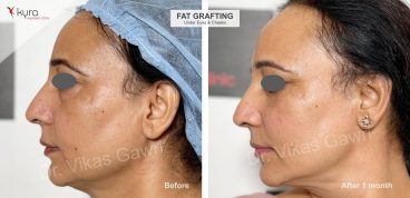 fat-grafting-to-under-eyes (3)