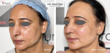 fat-grafting-to-under-eyes (5)