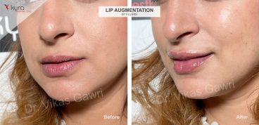 lip-augmentation (3)